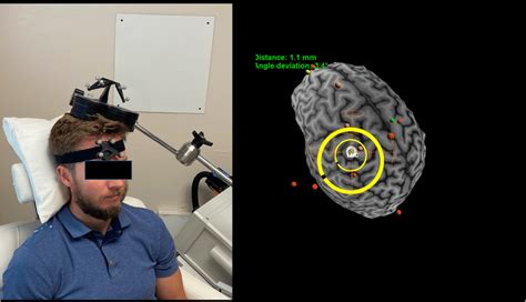 Magnetic Resonance Imaging Neuronavigation Guided Transcranial Magnetic
