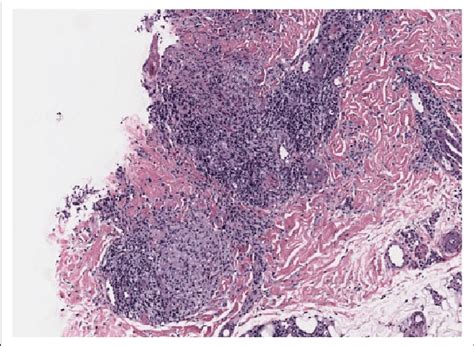 Within The Dermis Of The Biopsy Specimen A Granulomatous Infiltrate Is