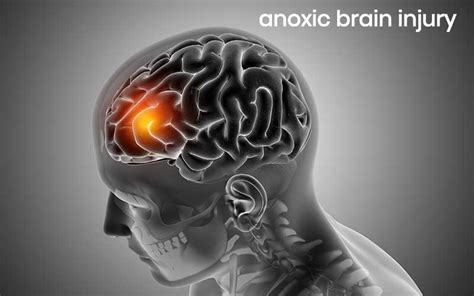 Anoxic Brain Injury Causes Symptoms And Treatment With Hbot