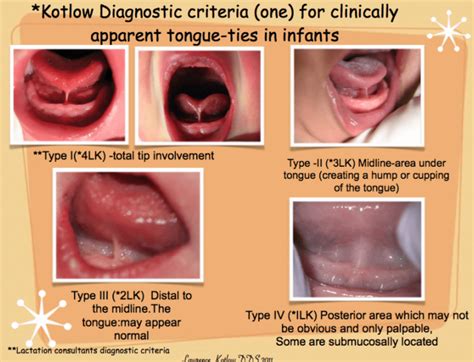 What Does A Tongue Tie Look Like Dr Chelsea Pinto Los Angeles Infant Tongue Tie Specialist