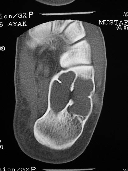 Treatment Of A Unicameral Bone Cyst Of Calcaneus With Endoscopic