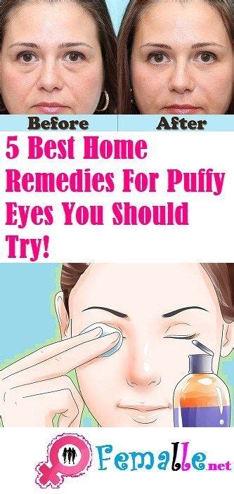 Best Home Remedies For Puffy Eyes You Should Try Puffy Eyes Remedy Cure Puffy Eyes Puffy Eyes