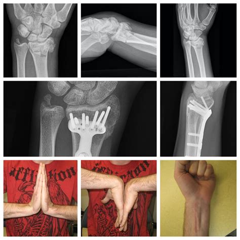 Broken Wrist Surgery In Raleigh
