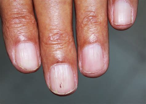 Nail Changes In Systemic Amyloidosis Litaiem 2021 Clinical Case