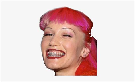 Gwen Stefani Before And After Braces