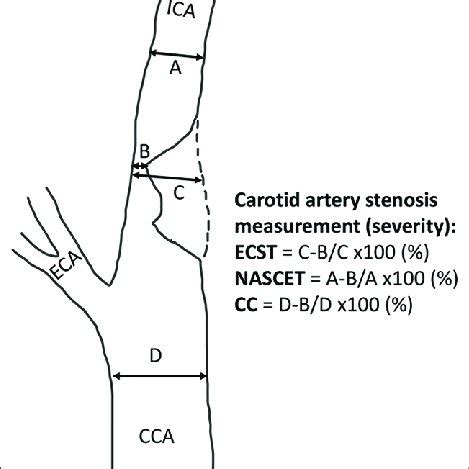 Methods Of Measurement Of Severity Of Carotid Artery Stenosis NASCET