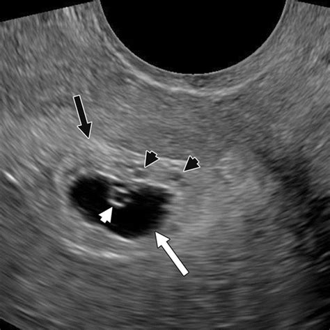 Gestational Trophoblastic Disease Clinical And Imaging Features