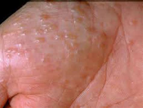 Kategori Punca Dan Cara Menangani Hand Dermatitis