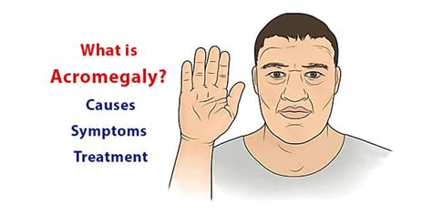 What Is Acromegaly Causes Symptoms And Treatment