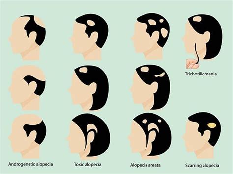 What Is Alopecia Everything You Need To Know About