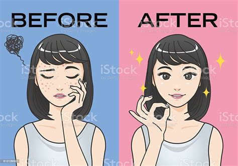 Acne Treatment Before After Image Illustration Stock Illustration