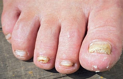 What Is The Best Over The Counter Toenail Fungus Treatment Human