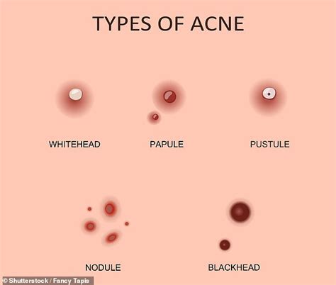 The Six Types Of Pimple And How To Deal With Each One Daily Mail Online