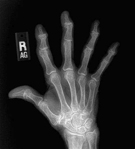What Does Hand Arthritis Look Like On X Ray John Erickson Md