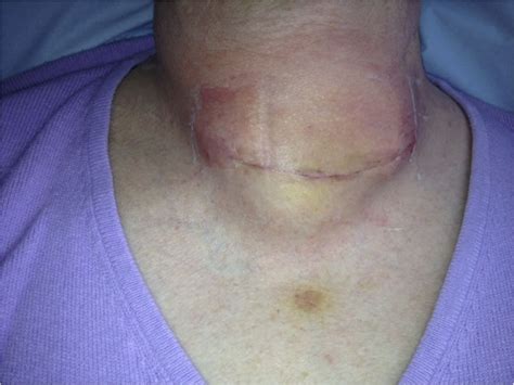 Neck Swelling After Thyroidectomy Not Always A Haematoma Bmj Case