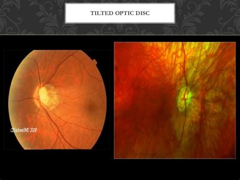 Congenital Malformation Of Optic Nerve And Choroid