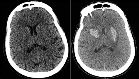 Bilateral Basal Ganglia Hemorrhage In A Patient With Confirmed Covid 19