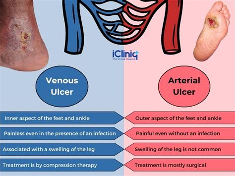 Arterial Vs Venous Ulcers What Are The Differences The Best Porn Website