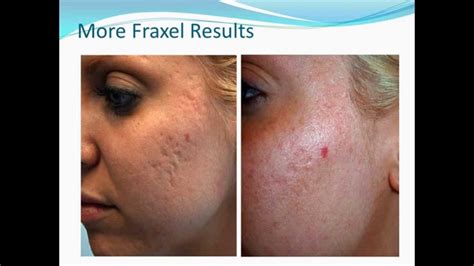 Fraxel For Acne Scars Youtube