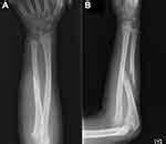 Full text Flexor Tendon Entrapment of the Index Finger ...