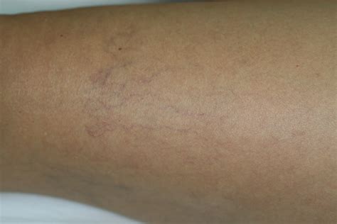 Vascular Lesions The Outcome Is All That Counts Laser Health Body Slim