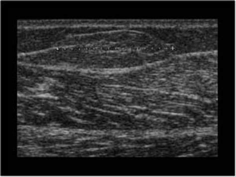Lipoma Ultrasound