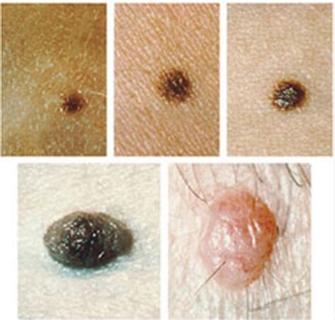 Skin Moles Types