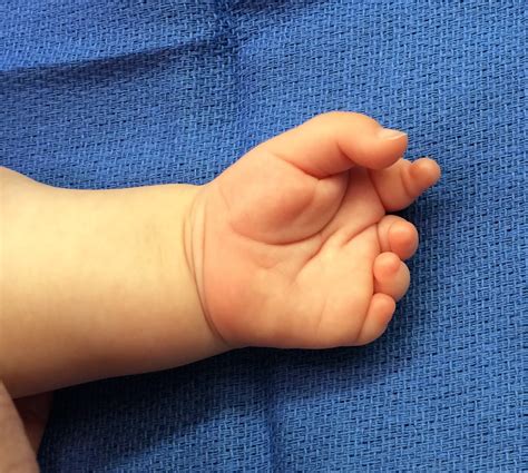 Short Fingers Treatment Choices Congenital Hand And Arm Differences