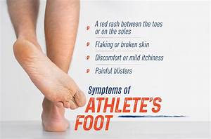 Symptoms Of Athlete 39 S Foot