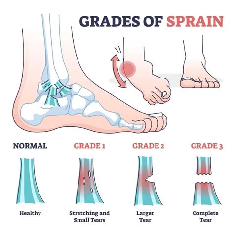 Sprained Ankle Grades A Comprehensive Guide