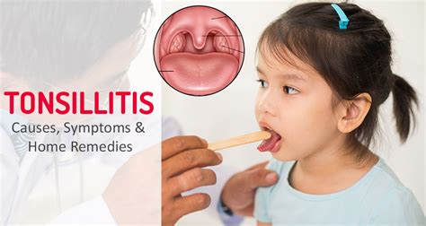 Tonsillitis Causes Symptoms And Home Remedies