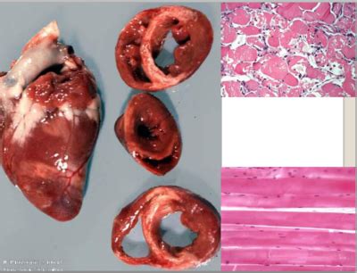 Resumen la miocarditis es una enfermedad inflamatoria del músculo cardiaco no asociada a anormalidades valvulares y en ausencia de enfermedad isquémica. Patologías Cardiovasculares Patologías musculares | Quiz