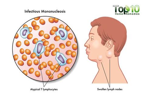 Mononucleosis Explained Causes Symptoms And Natural Remedies Top 10