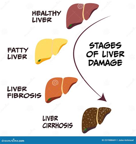 Stages Of Liver Damage Liver Disease Healthy Fatty Liver Fibrosis