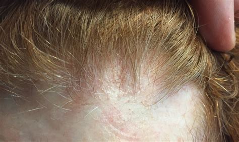 Do I Have Frontal Fibrosing Alopecia — Donovan Hair Clinic