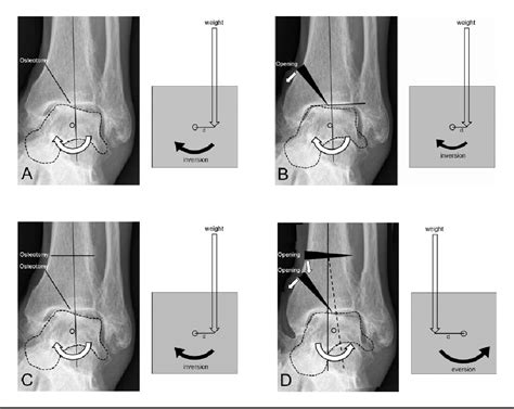 Figure 1 From Novel Double Osteotomy Technique Of Distal Tibia For