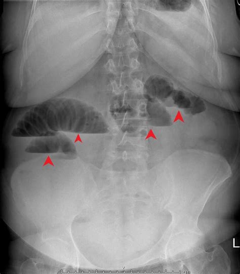 Small Bowel Obstruction X Ray