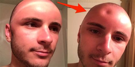 Photos Of A Mans Sunburned Head Are Going Viral Business Insider