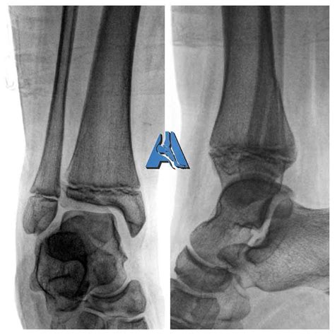 Tri Plane Ankle Fracture Salter Harris Fracture Fixed With Ankle