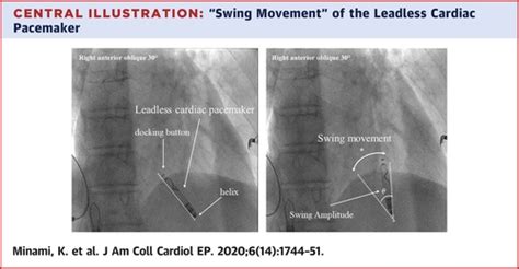 Retrieval Of Long Term Implanted Leadless Pacemakers A Single Center