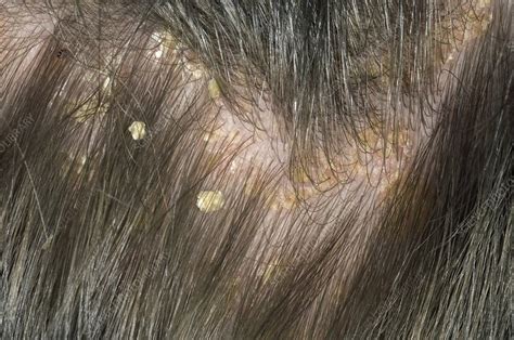 Psoriasis On The Scalp Stock Image C0085731 Science Photo Library