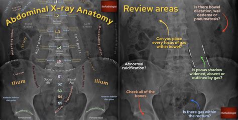 Abdominal X Ray Anatomy And Interpretation Checklist Grepmed