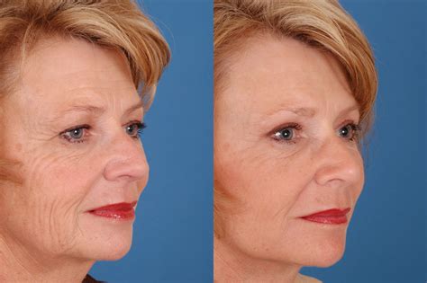 Facelift Before And After Photos Benjamin Bassichis Md Facs