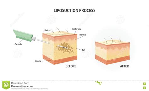 Liposuction Process Stock Vector Illustration Of Skin 72236025