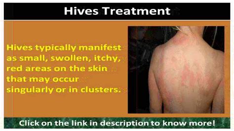 Hives Medical Treatment Youtube