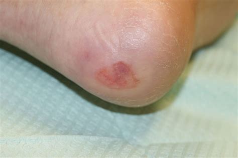 Best Diabetic Neuropathy Wounds And Foot Pain Solutions