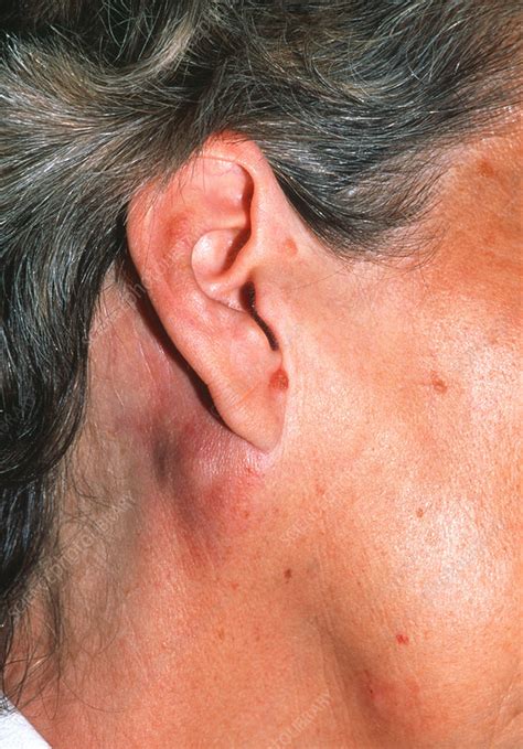 Lymphoma Behind Ear