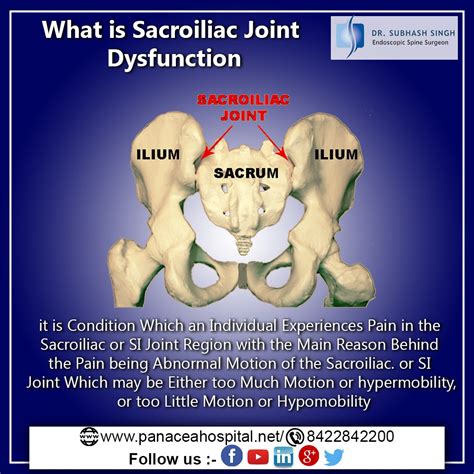 WHAT IS SACROILIAC JOINT DYSFUNCTION