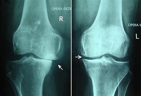 Knee Osteoarthritis Physiopedia
