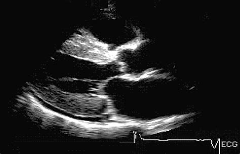 Utility Of Echocardiography In The Evaluation Of Individuals With